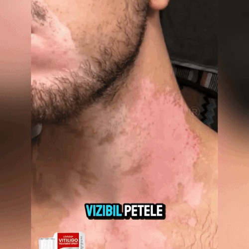 Vitiligo Spray-Tratament pentru VITILIGO
