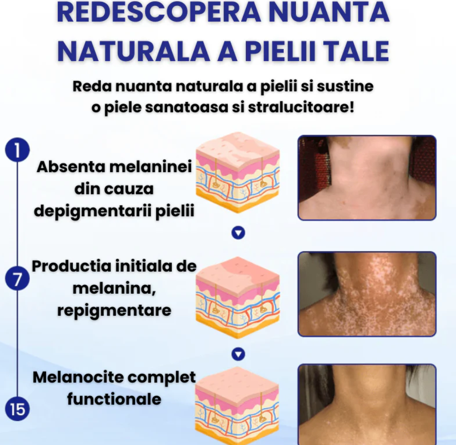 Vitiligo Spray-Tratament pentru VITILIGO