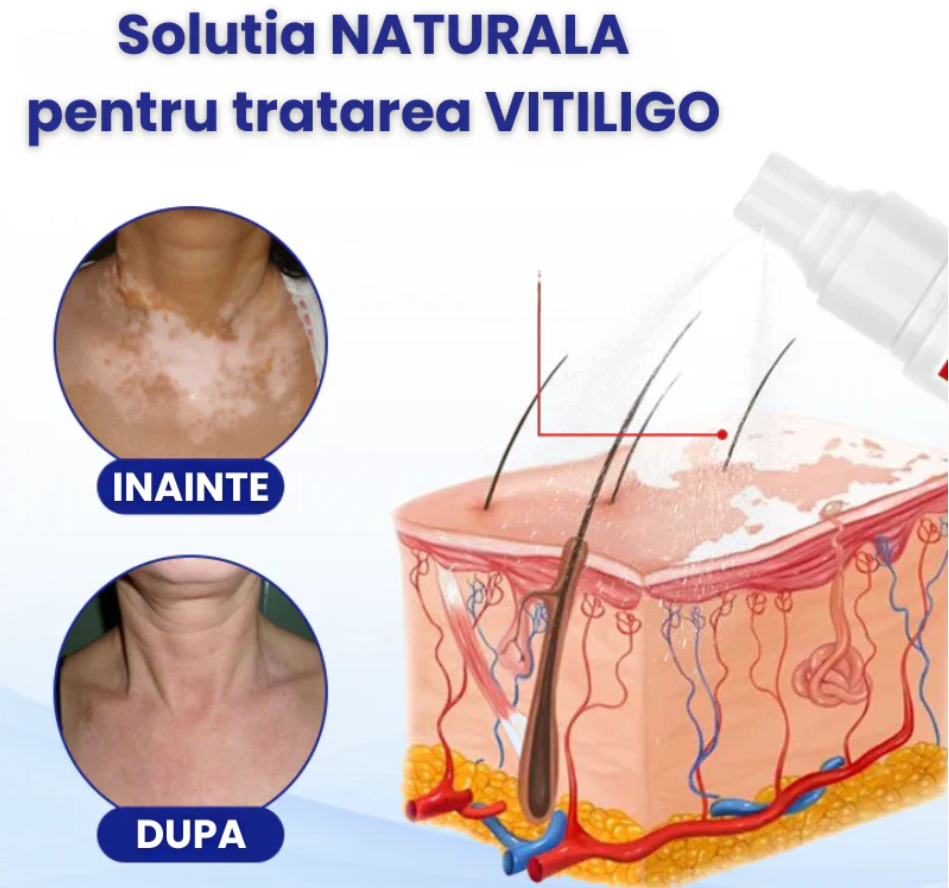 Vitiligo Spray-Tratament pentru VITILIGO